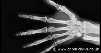 Wearside out of hours x-ray services to be scrapped