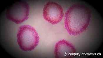 'Signs of hope': 2 patients recover from COVID-19 in Alberta