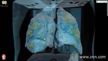 Video reveals lung damage in coronavirus patient: 'People need to take this seriously'