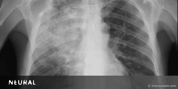 Claims that AI detects coronavirus in X-rays aren’t convincing medical experts