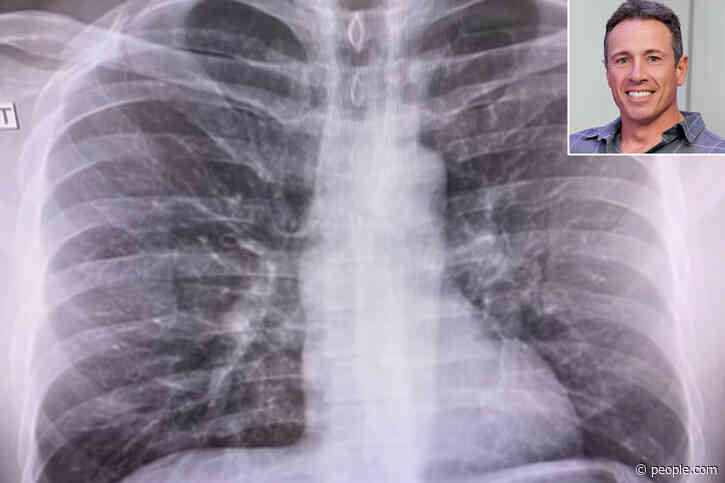 Chris Cuomo Shares Chest X-Rays as He Battles Coronavirus: 'You Have to Fight to Keep It Out'