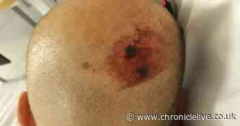 Attack victim reveals injuries after stag do ends in violence