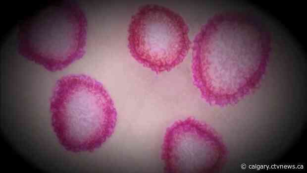 Staff member of southeast Calgary care centre diagnosed with COVID-19