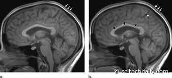 Astronaut Brain Volume Changes and Pituitary Gland Deforms During Long Spaceflights