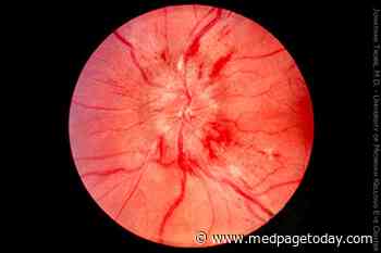 High Marks for AI to Detect Papilledema