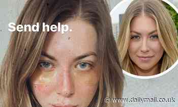 Stassi Schroeder tells fans to 'send help' as she bravely reveals psoriasis breakout on her face