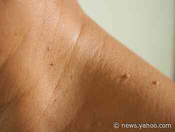 How to identify and remove a skin tag