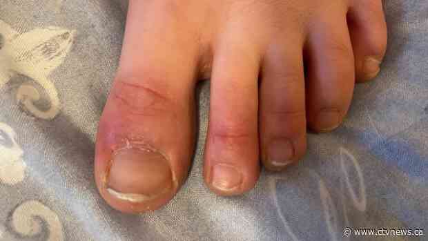 Pediatricians warned about 'COVID toes' in children infected with COVID-19