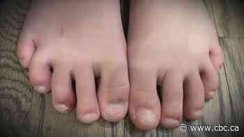 What doctors and parents should watch for when COVID-19 affects children, including 'COVID toes'