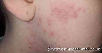 Five skin conditions associated with coronavirus found by dermatologists