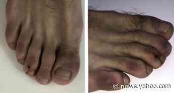 "COVID toes" may be coronavirus symptom