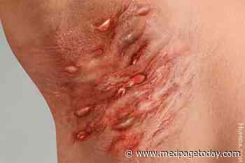 Hidradenitis Suppurativa Closely Linked with Childhood Weight