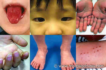 Kawasaki Disease From COVID-19 in Kids: How Common?