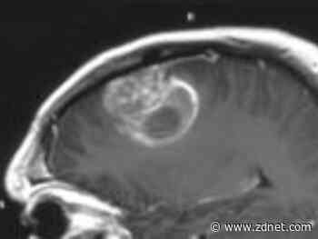 Intel, UPenn partner with 29 health organizations to train AI to spot brain tumors