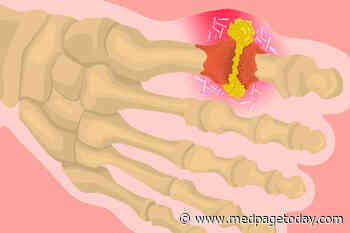 New ACR Gout Guideline Boasts Better Evidence