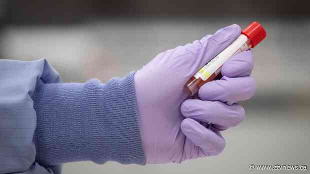 Health Canada approves first test to detect antibodies for COVID-19