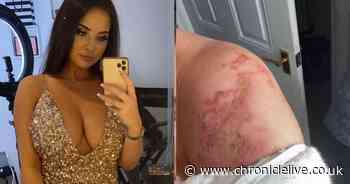 Newcastle glamour model's hair and skin scorched after garden fire accident