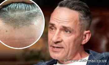 Married At First Sight: Steve Burley breaks silence on hair transplant rumours