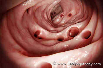 Interval Resection Does Not Cut Surgery or Death in Complex Diverticulitis