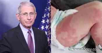 As cases of rare COVID-linked illness in kids rise, Fauci warns much remains unknown