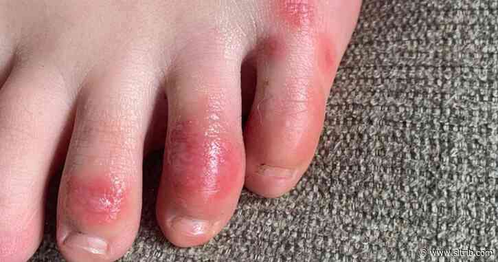 ‘COVID toes,’ other rashes are the latest rare-but-possible signs of the coronavirus