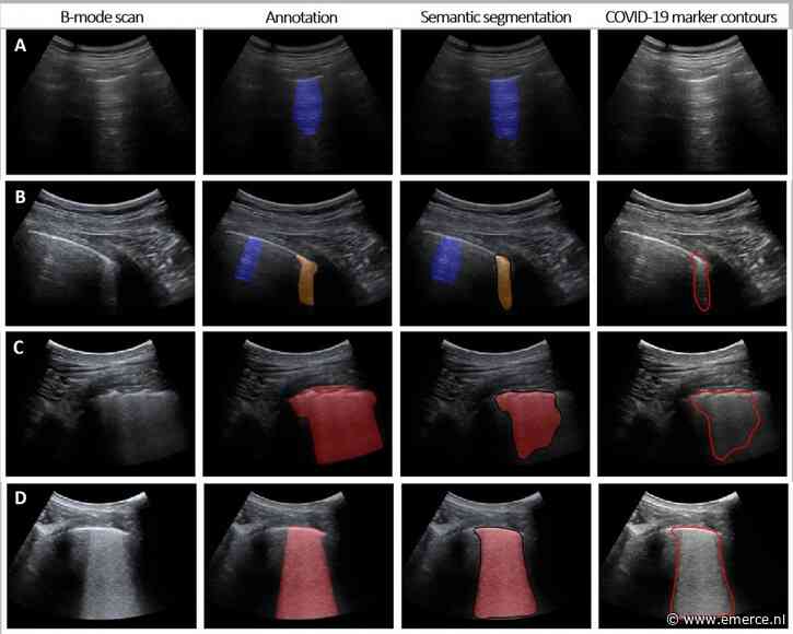 Intelligente longecho biedt snelle ondersteuning bij COVID-19 testen