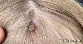 Albertans reporting fewer ticks amid social distancing; Expert predicts numbers will rise