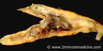 Carotid endarterectomy and medical therapy reveal similar effectiveness in asymptomatic carotid stenosis - 2 Minute Medicine