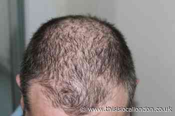 Bald men could be at greater risk of coronavirus, research suggests
