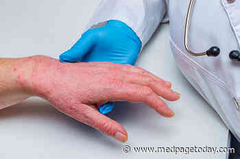 Once-Daily Abrocitinib Succeeds for Atopic Dermatitis