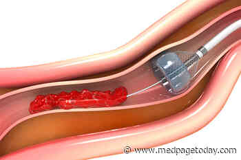 Stroke Thrombectomy's Benefits Hold Strong in Developing World
