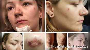 'I could feel broken teeth in my mouth;' Saskatoon police chief orders review after woman alleges police brutality - CTV News Saskatoon
