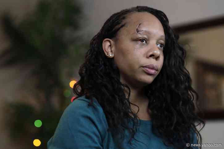 Protester hit in face by police rubber bullet wants answers