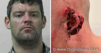 Graphic photo shows horrific ear bite injury inflicted on teenager in bar brawl