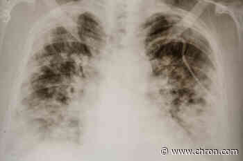 What they don’t tell you about surviving COVID-19