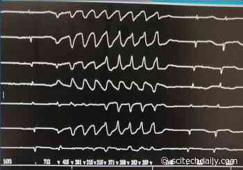 Potentially Deadly Heart Rhythm Disturbance Induced by Chloroquine Therapy for COVID-19