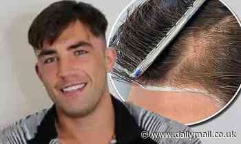 Love Island's Jack Fincham, 29, reveals he's had a hair transplant to cover up scar