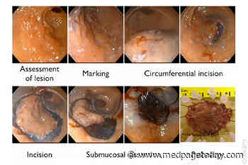 Endoscopic Procedure Wins in Early Stomach Cancer