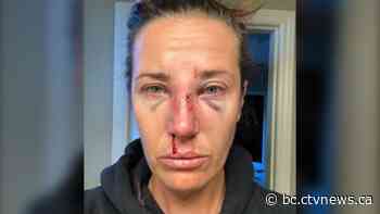 'I couldn't breathe': Nanaimo woman left bruised, bloody after RCMP wellness check