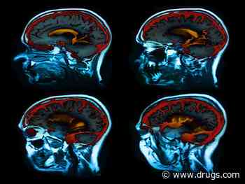 Brain Iron Concentrations Increased in Alzheimer Disease