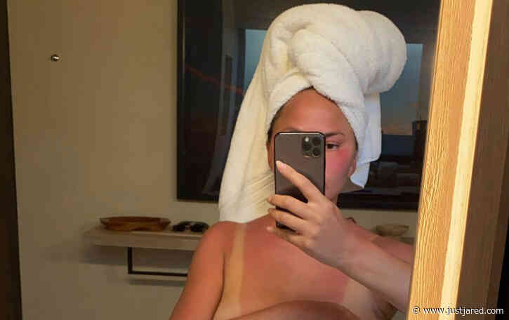 Chrissy Teigen Goes Topless to Show Off Her Sunburn
