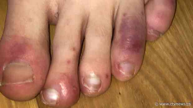 New study finds evidence between COVID-19 and 'COVID toes' symptom