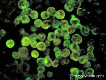 Rare case of brain-destroying amoeba confirmed in Florida