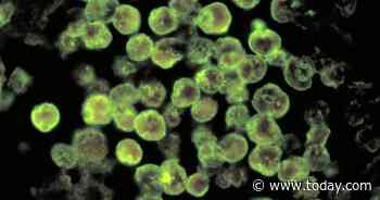 Case of rare 'brain-eating amoeba' diagnosed in Florida