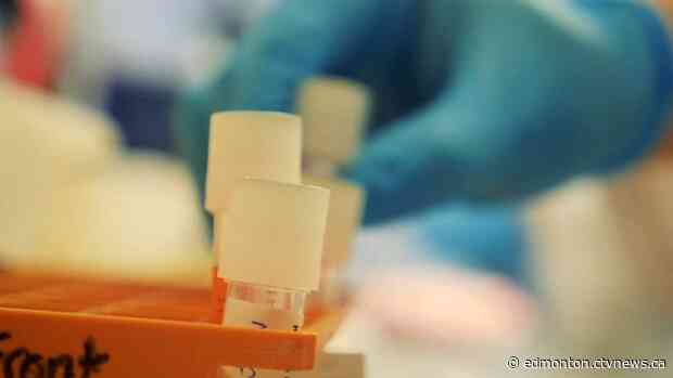 Alberta to release updated COVID-19 numbers for Wednesday, July 8