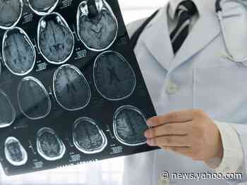 The coronavirus may cause brain damage, even in patients with mild cases, a new study found