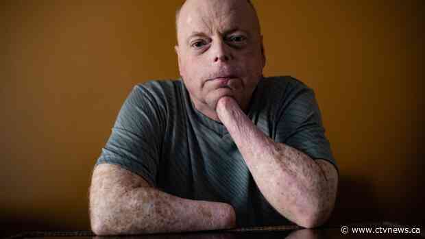 B.C. man prepares to be first to receive double-hand transplant in Canada