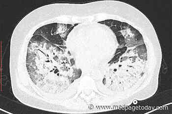 CT Useless for COVID-19 Diagnosis, Study Affirms