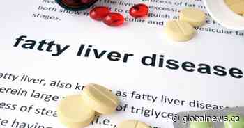 Fatty liver disease a growing public health concern in Canada: study