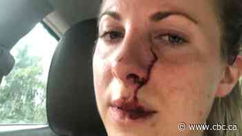 Runner thankful to be alive after being swatted by bear in Riding Mountain National Park